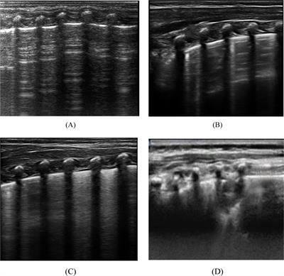 A study of machine learning to predict NRDS severity based on lung ultrasound score and clinical indicators